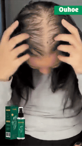 💆♀️ OUHOE Suero Capilar con Minoxidil 4% – Crecimiento y Fortalecimiento 🚀