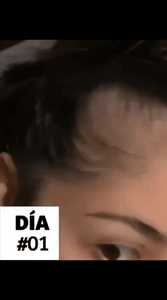 💆♀️ OUHOE Suero Capilar con Minoxidil 4% – Crecimiento y Fortalecimiento 🚀
