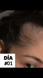 💆♀️ OUHOE Suero Capilar con Minoxidil 4% – Crecimiento y Fortalecimiento 🚀
